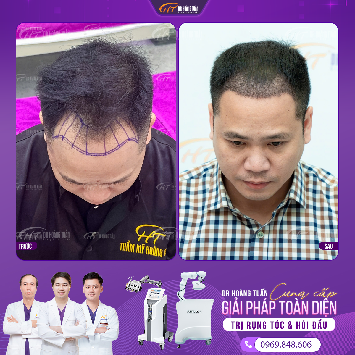 hói đầu có chữa được không